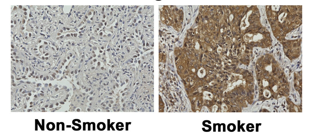 Samples of nonsmoker versus smoker lung cancer cells as seen under a microscope